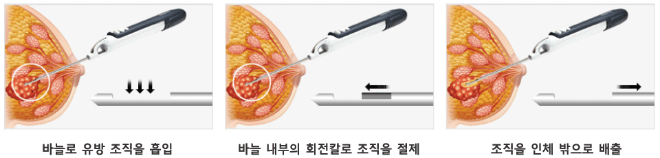 바늘로 유방 조직을 흡입 바늘내부의 회전칼로 조직을 절제 조직을 인체 밖으로 배출